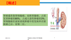 肾癌病人的医疗护理培训课件.ppt