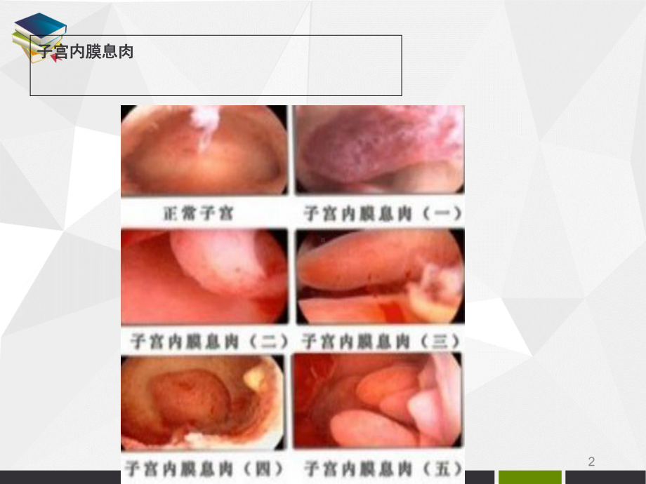 子宫内膜息肉医学课件.ppt_第2页