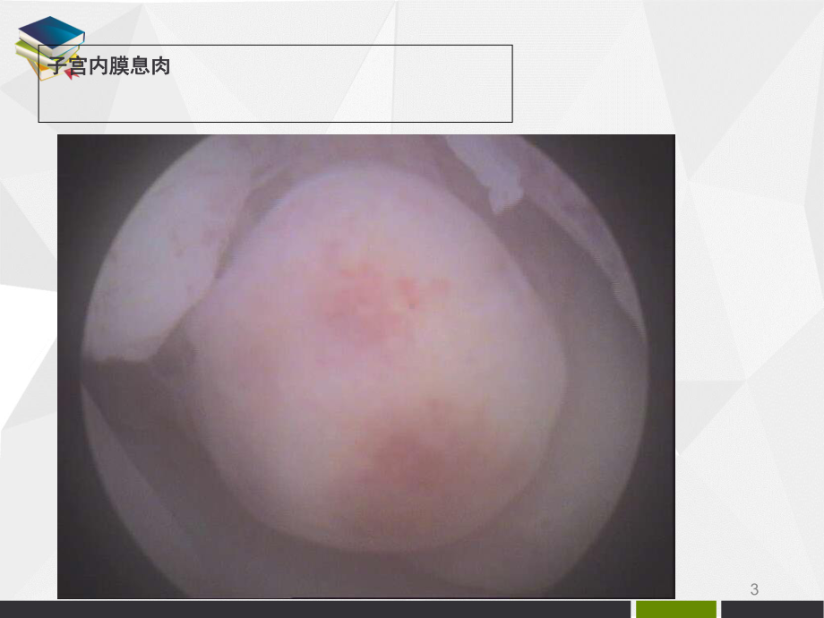 子宫内膜息肉医学课件.ppt_第3页