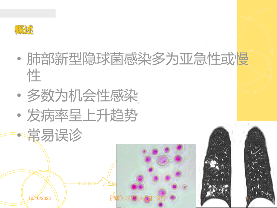 肺隐球菌病CT诊疗培训课件.ppt_第1页