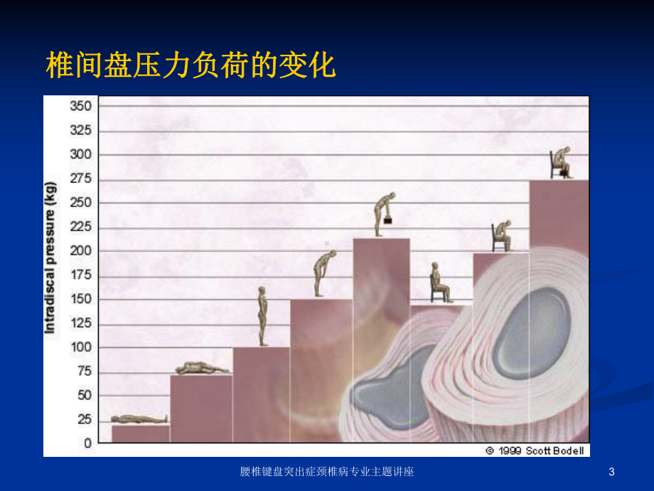 腰椎键盘突出症颈椎病专业主题讲座培训课件.ppt_第3页