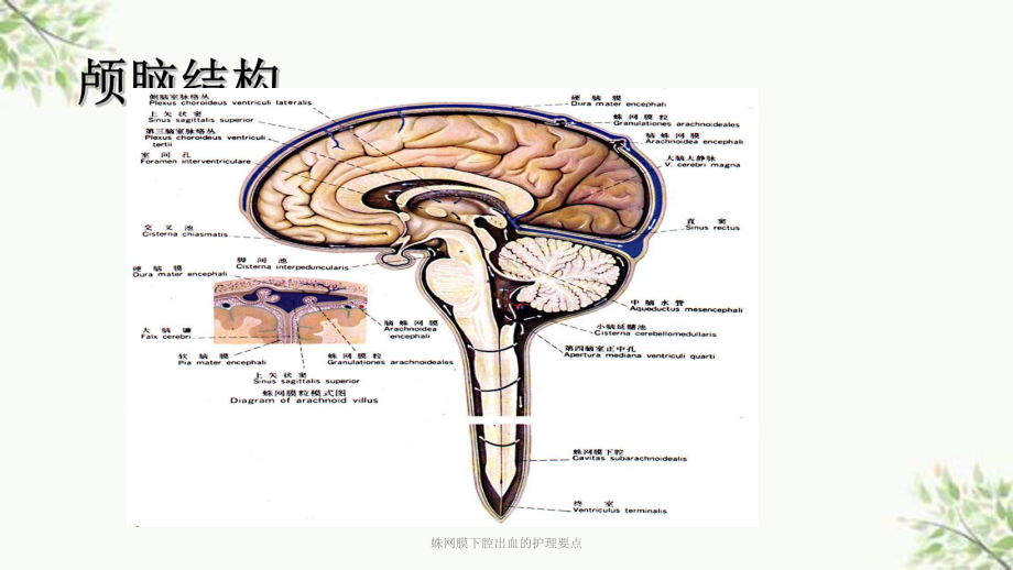 蛛网膜下腔出血的护理要点课件.ppt_第2页