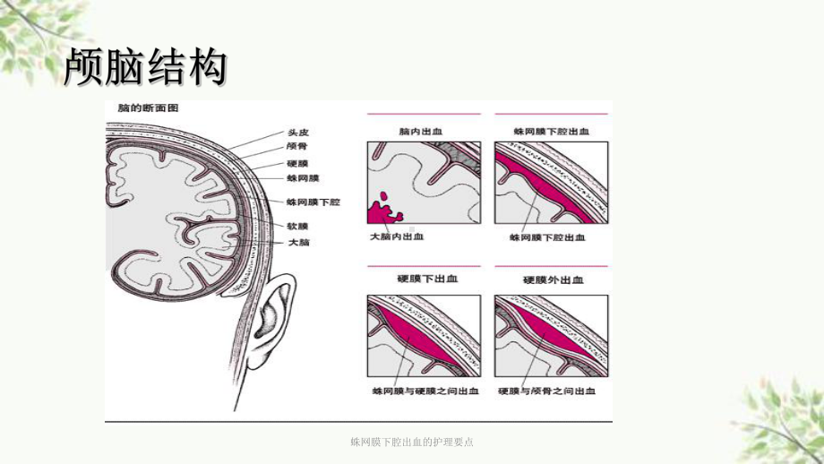 蛛网膜下腔出血的护理要点课件.ppt_第3页