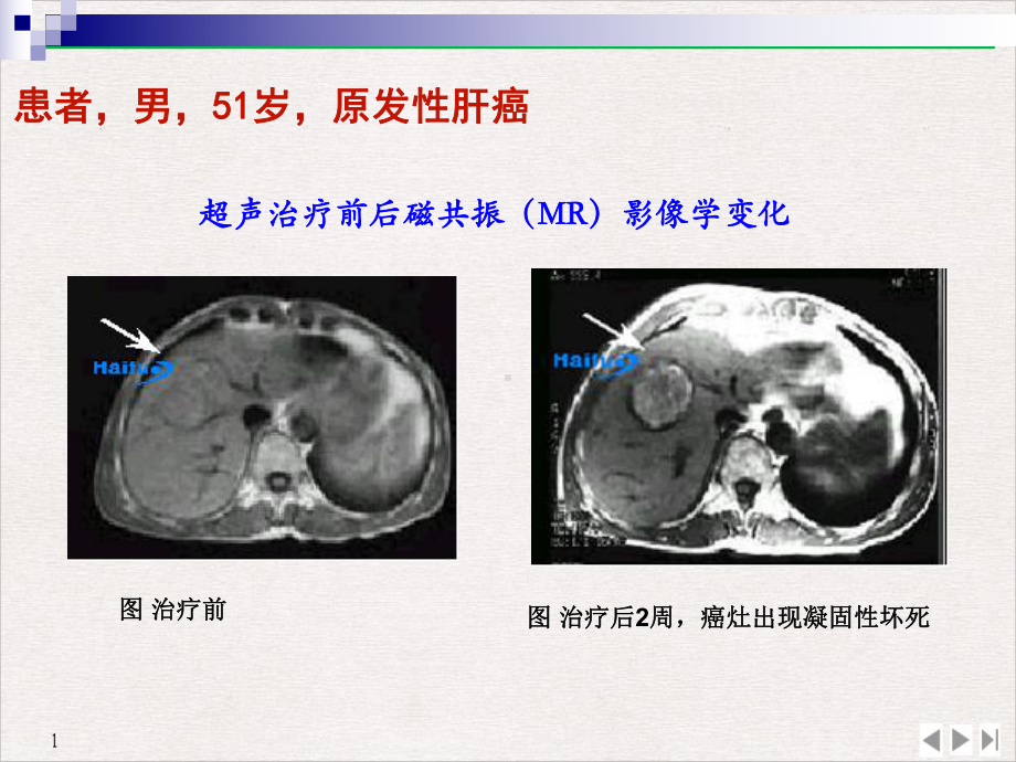 超声的生物效应及诊断概述解析课件.pptx_第3页