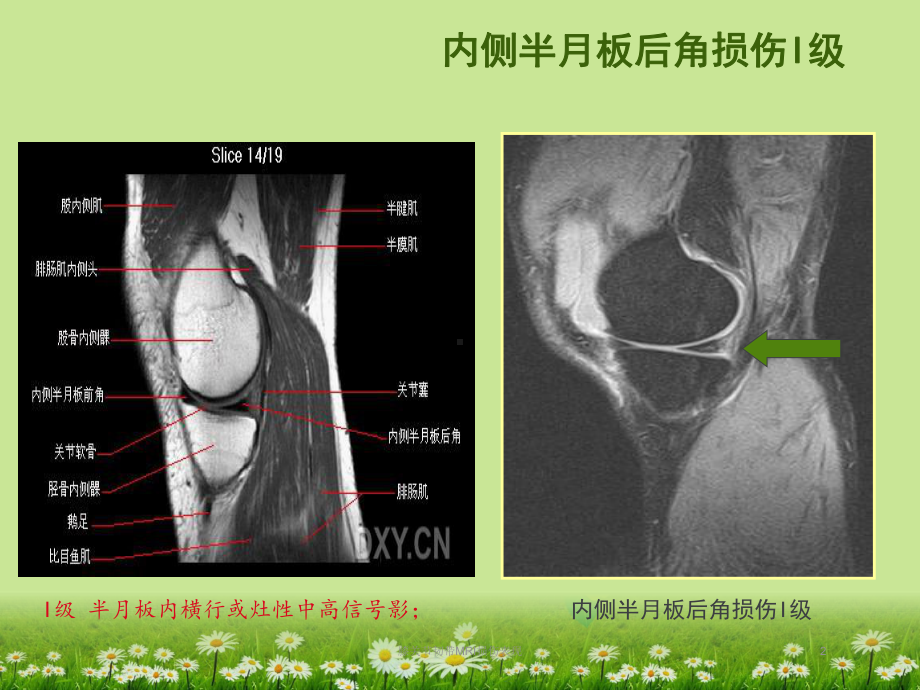 膝关节韧带MRI损伤表现培训课件.ppt_第2页