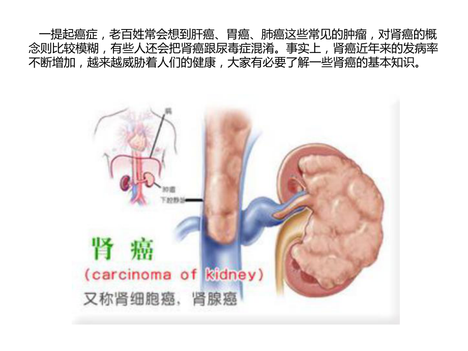 权威专家详细解读肾癌的7个知识课件.ppt_第2页