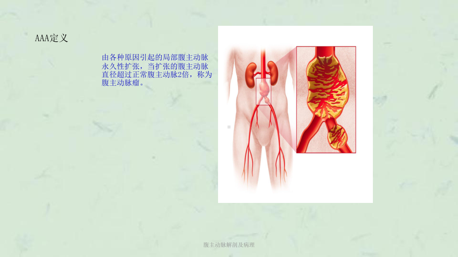 腹主动脉解剖及病理课件.ppt_第3页