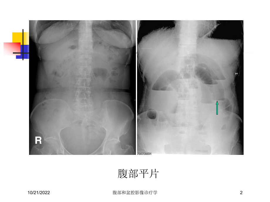 腹部和盆腔影像诊疗学培训课件.ppt_第2页