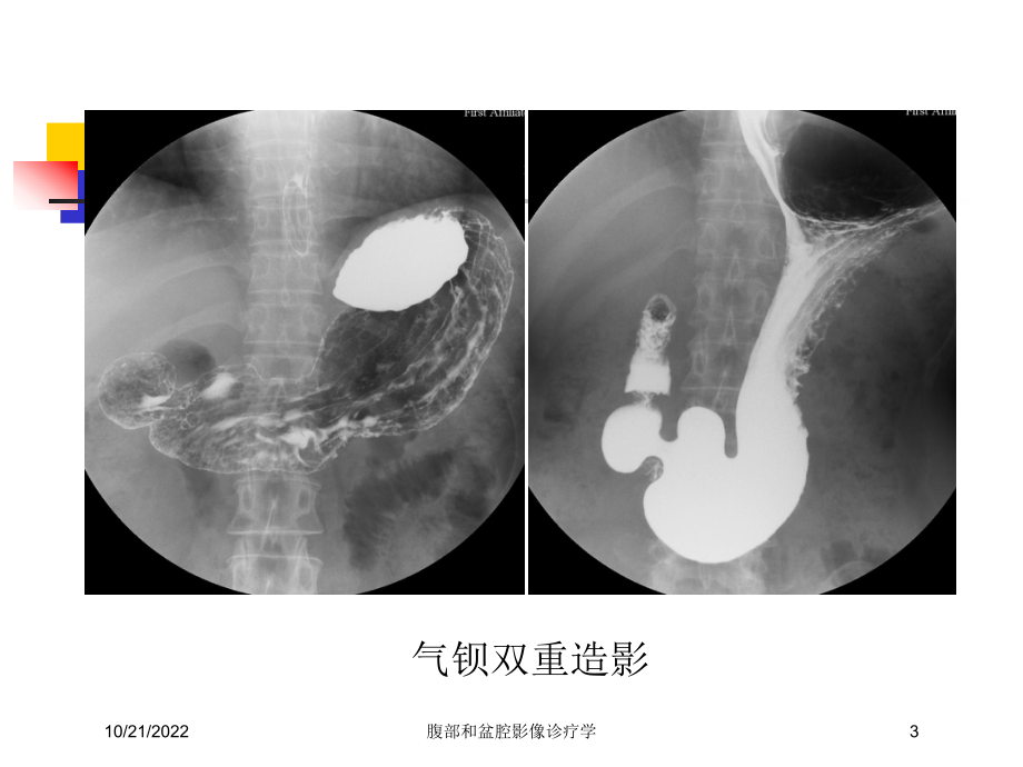 腹部和盆腔影像诊疗学培训课件.ppt_第3页