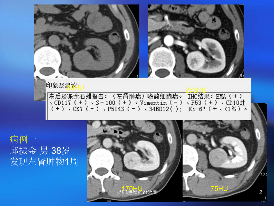 肾细胞癌的ct诊断课件.ppt_第2页