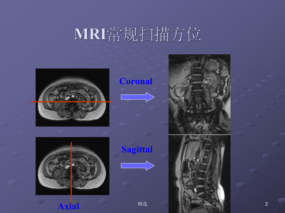 脊柱正常MRI表现及常见疾病课件.ppt_第2页