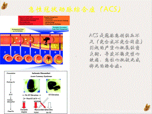 非st段抬网高acs危险评估及治疗策略课件.pptx