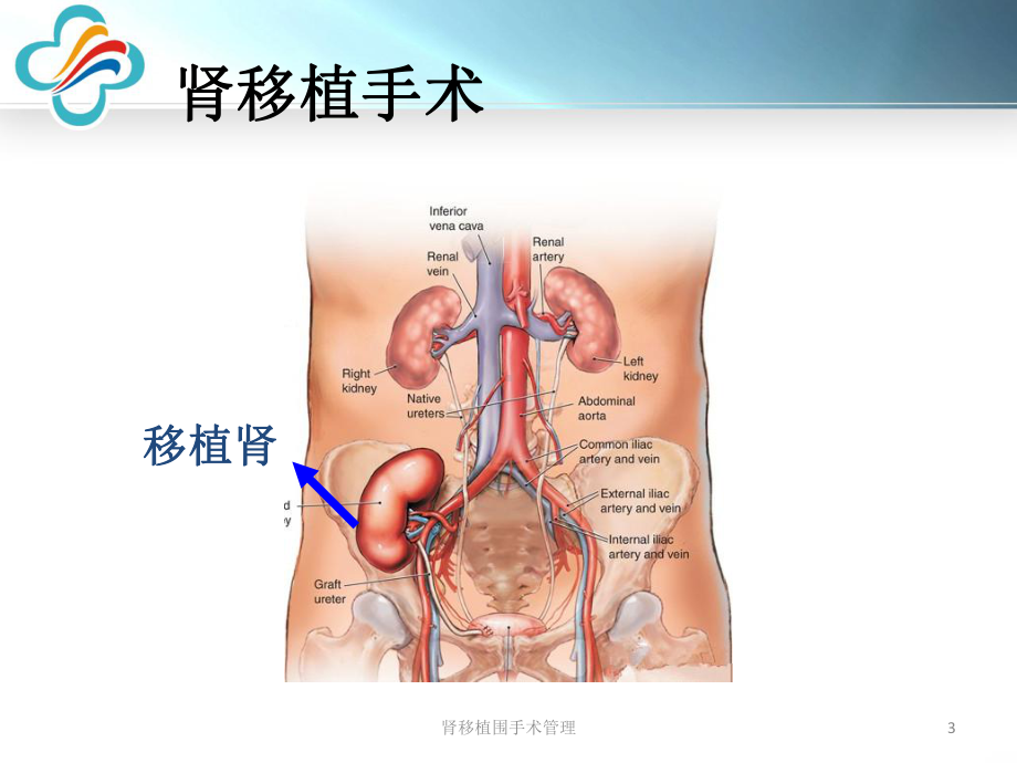 肾移植围手术管理课件.ppt_第3页