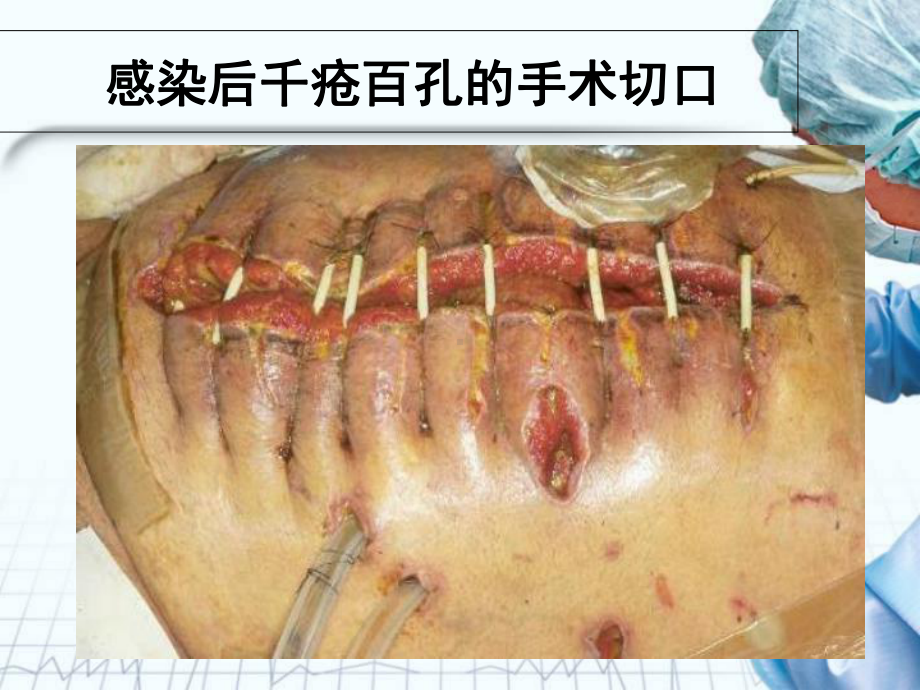 近年国内医院感染案例整理汇总培训课件-2.ppt_第3页