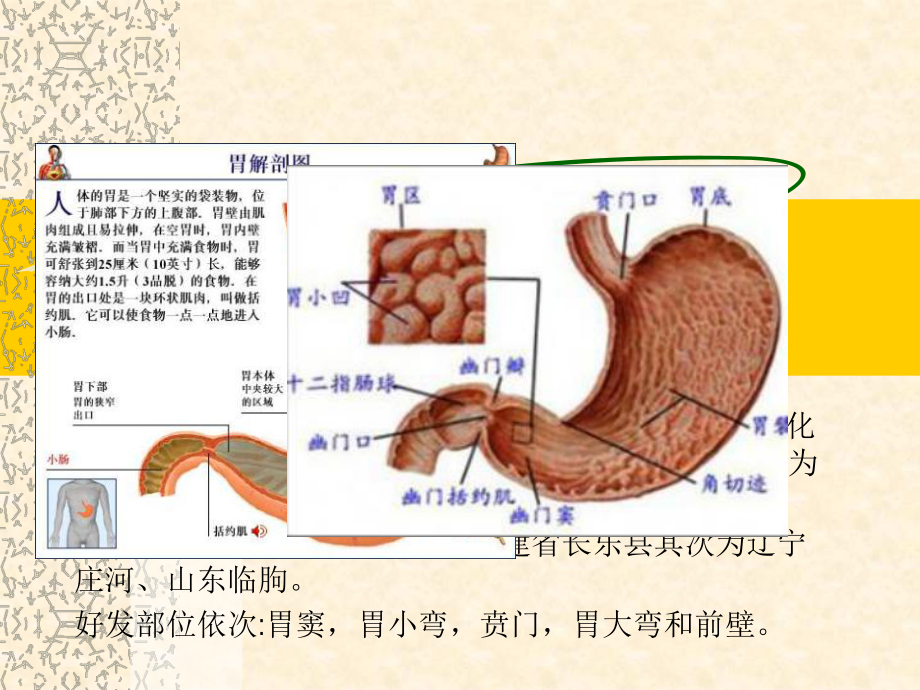 胃癌术后并发症护理课件.ppt_第2页