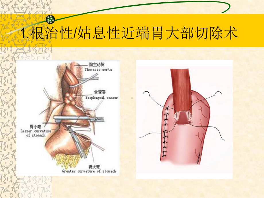 胃癌术后并发症护理课件.ppt_第3页