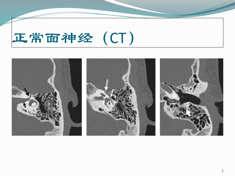 面神经解剖及病变学习课件.ppt_第3页