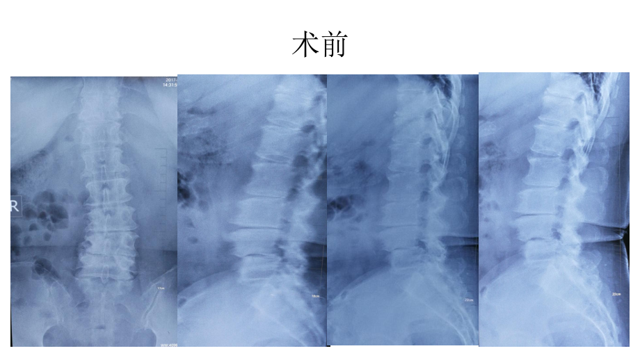 腰椎椎间孔狭窄脊柱内窥镜治疗课件.ppt_第3页