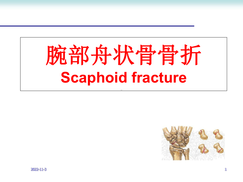 腕部舟状骨骨折学习课件.ppt_第1页