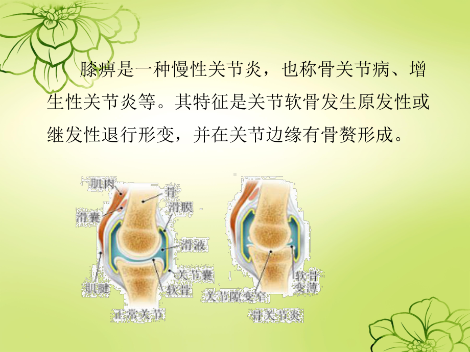 膝痹病中医护理方案课件.pptx_第2页