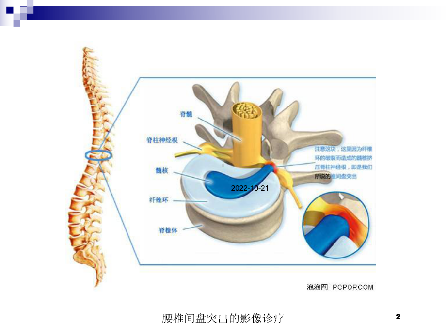 腰椎间盘突出的影像诊疗培训课件.ppt_第2页