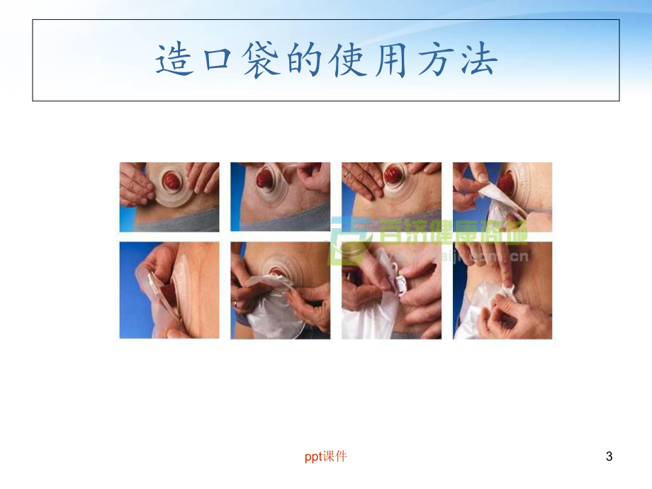 造口病人的生活护理与指导-课件.ppt_第3页