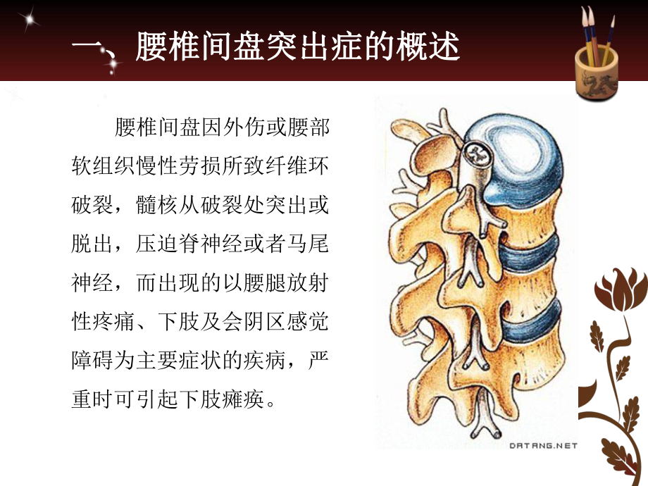 腰椎间盘突出症教学课件-.pptx_第3页