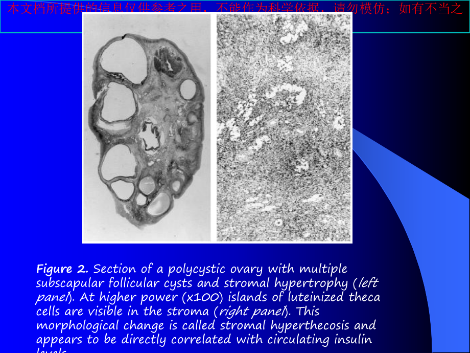 胰岛素抵抗和多囊卵巢综合征解析培训课件.ppt_第2页