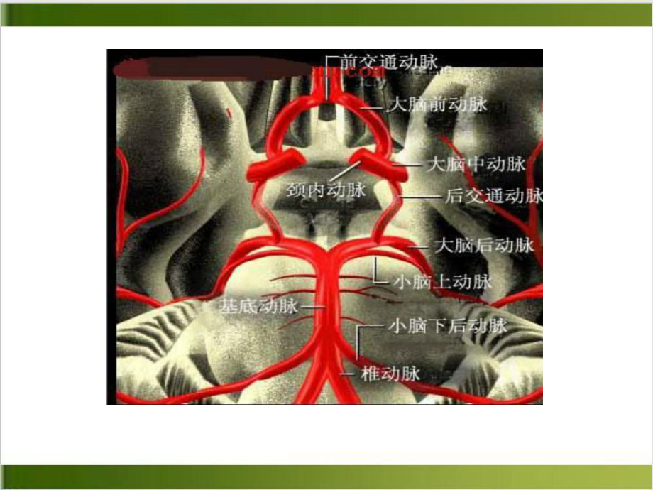 颅内动脉瘤护理查房培训教材课件.ppt_第3页