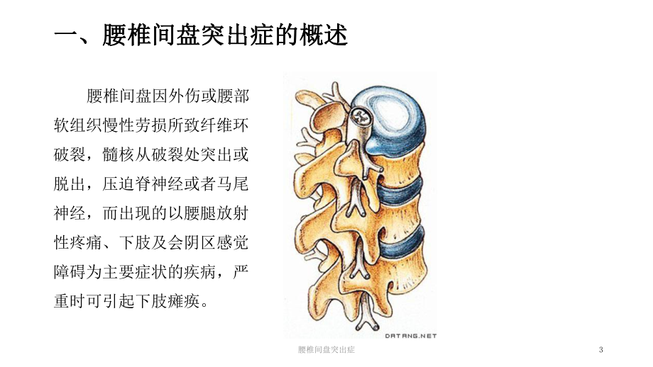 腰椎间盘突出症课件.pptx_第3页