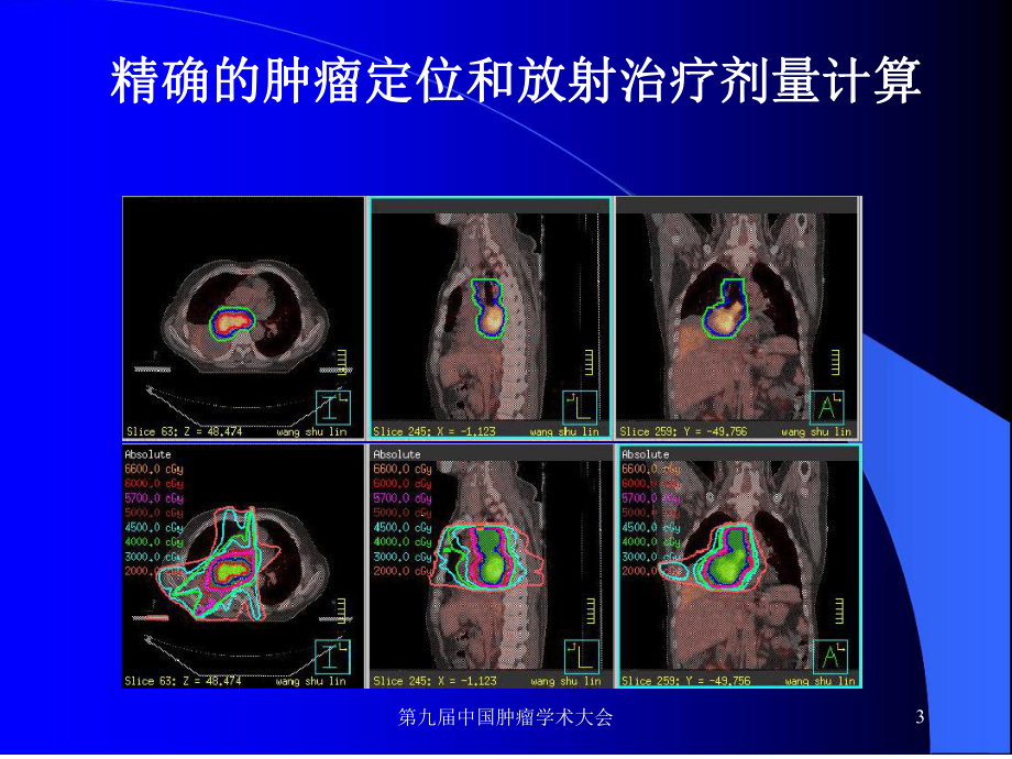 非小细胞肺癌放射治疗进展非小细胞肺癌放射治疗课件.ppt_第3页