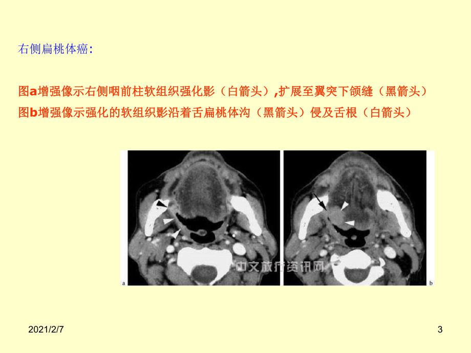 肿瘤影像与放疗(头颈口咽癌)课件.ppt_第3页