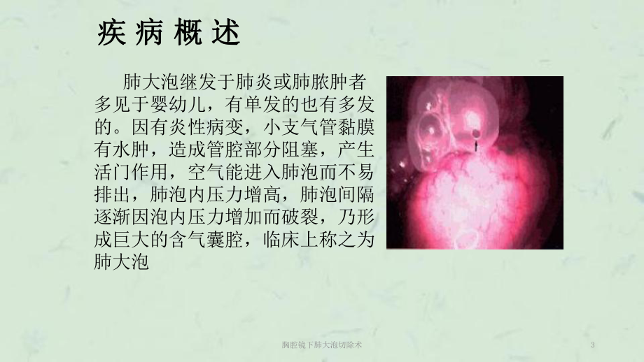 胸腔镜下肺大泡切除术课件.ppt_第3页