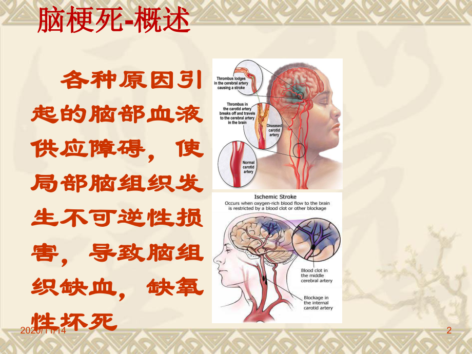 脑梗死临床表现与治疗培训课件.ppt_第2页