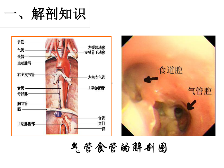 气管食管瘘讲义课件.ppt_第3页