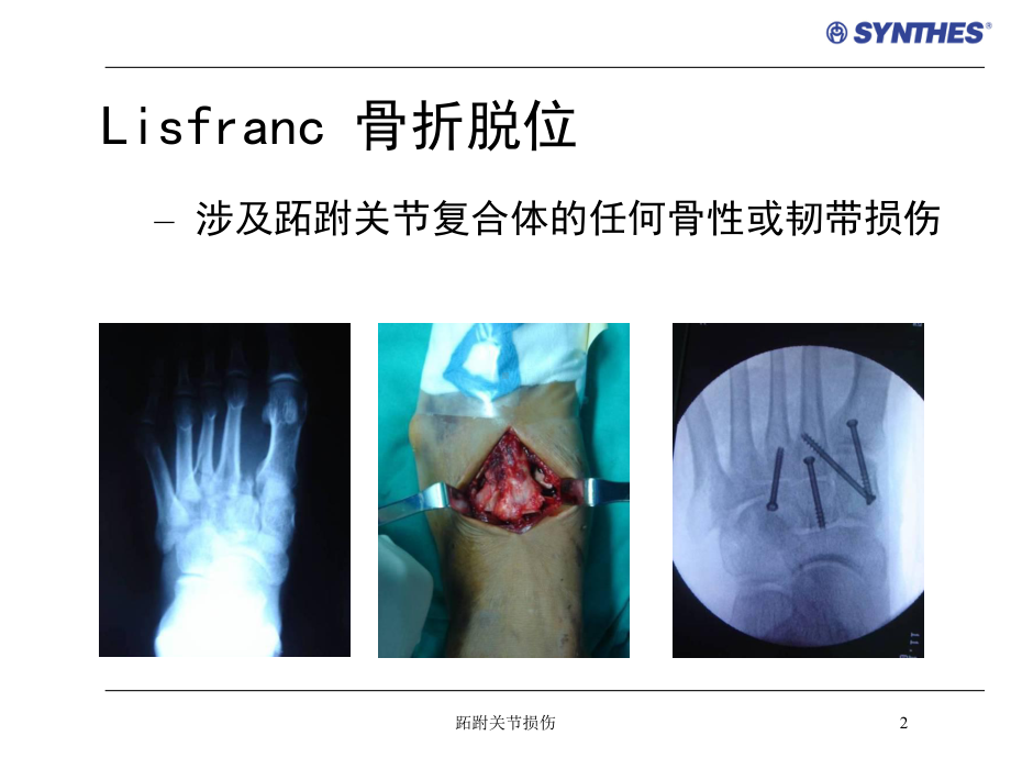 跖跗关节损伤培训课件.ppt_第2页