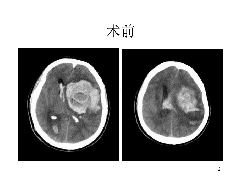 脑外科教学查房课件-2.ppt_第2页