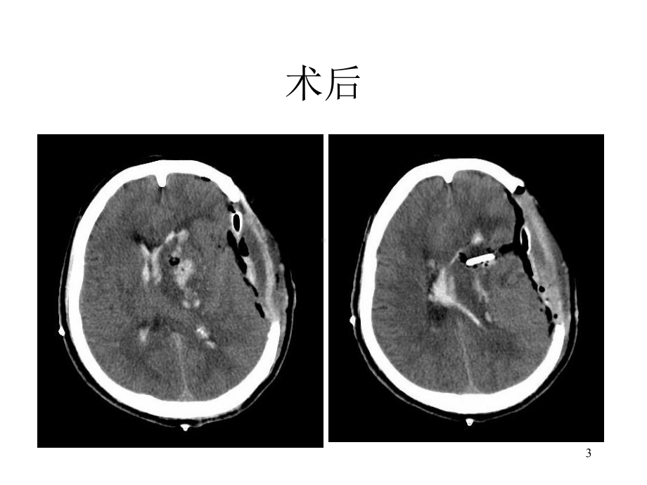 脑外科教学查房课件-2.ppt_第3页