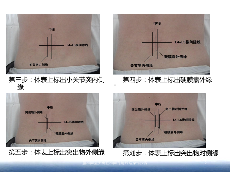 腰椎间盘突出症椎间孔镜后路操作步骤培训课件.ppt_第2页