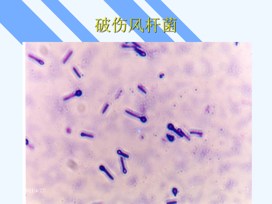 预防医学新生儿破伤风的病因临床表现预防及治疗课件.ppt_第2页