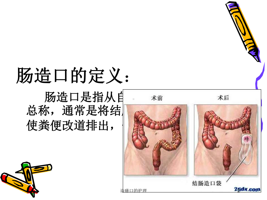 造瘘口的护理培训课件.ppt_第2页