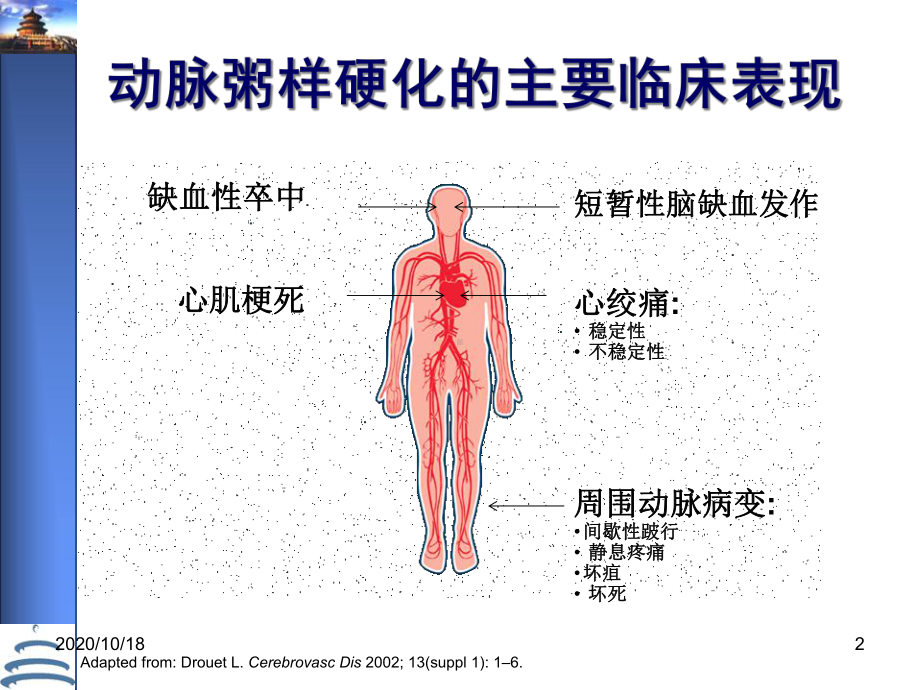 脑动脉粥样硬化的诊断与治疗策略优选课件.ppt_第2页