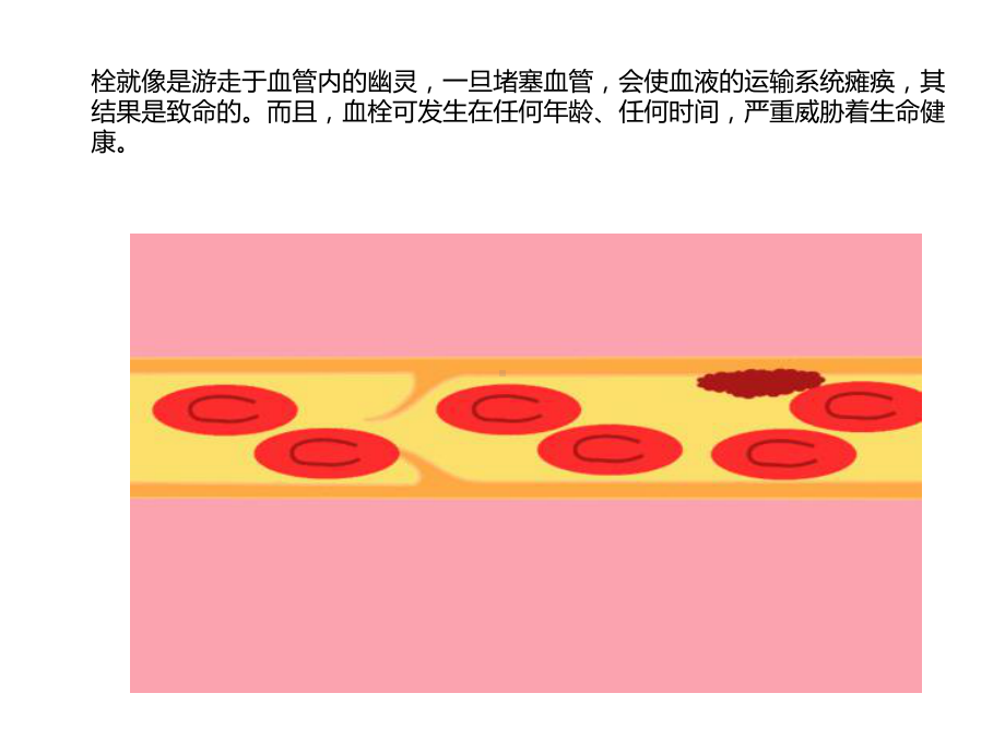 百分之九十九的血栓无任何征兆!课件.ppt_第2页