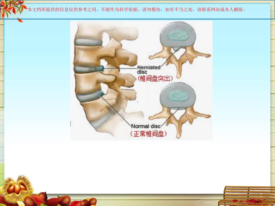 腰椎间盘突出症主题讲座培训课件.ppt_第3页