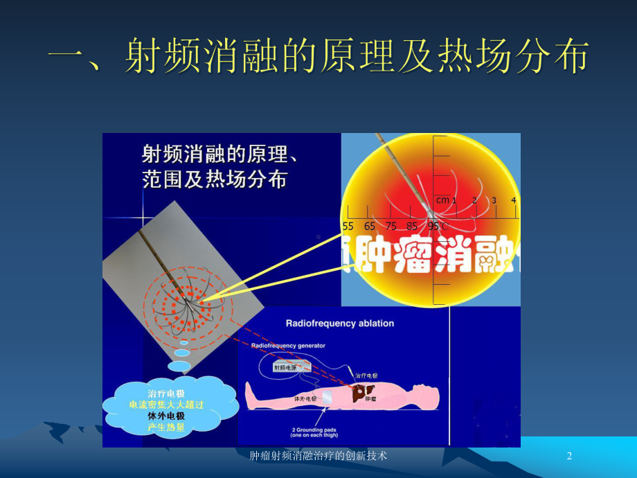 肿瘤射频消融治疗的创新技术培训课件.ppt_第2页