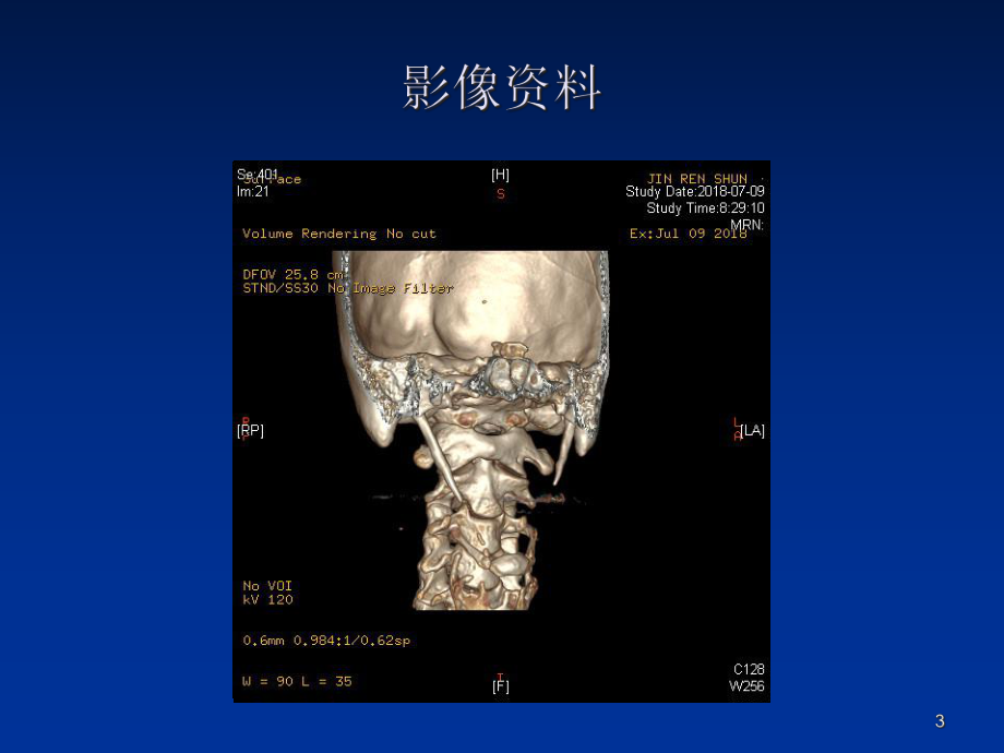 茎突过长综合征课件.ppt_第3页