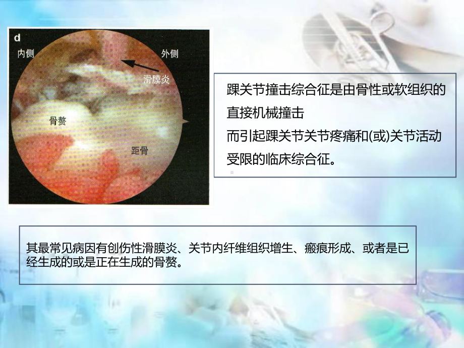 踝前撞击综合征课件.ppt_第2页