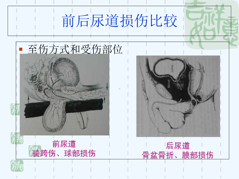 尿道损伤的治疗与护理课件.ppt_第3页