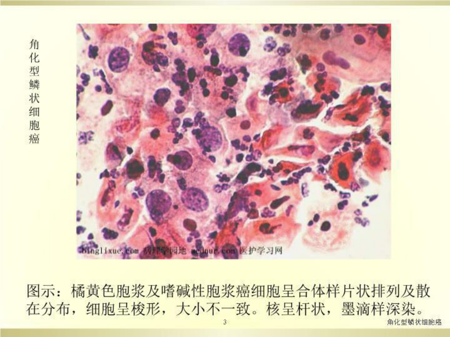 角化型鳞状细胞癌培训课件.ppt_第3页