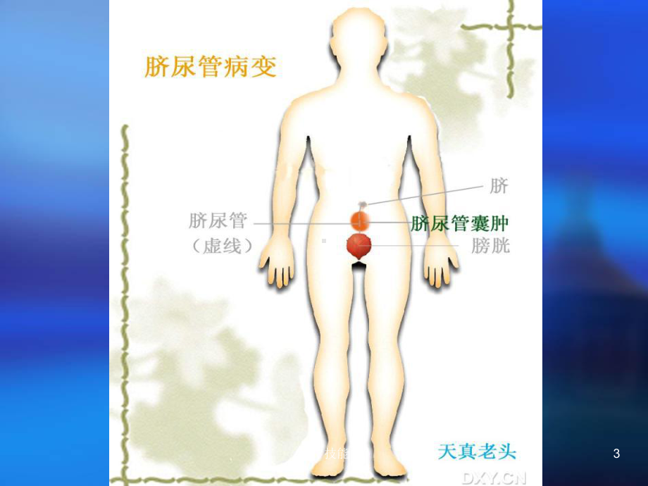 脐尿管疾病的超声诊断(特制医疗)课件.ppt_第3页